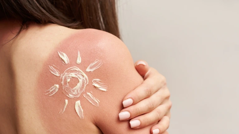 Sonnenbrand Sonnencreme Sonne Urlaub Strand — © Bild: Pridannikov / iStock